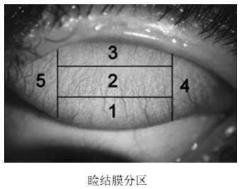 软性接触镜临床试验指导原则（2018年第51号）(图2)