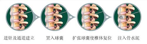 骨水泥套管组件注册技术审查指导原则（2018年第107号）(图1)